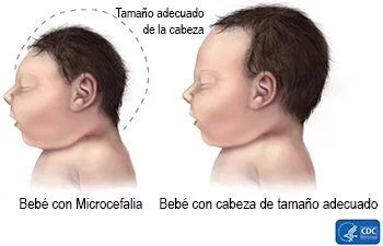 Comparación de un caso de microcefalia, con uno sin la enfermedad.